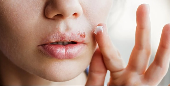 Herpes labial