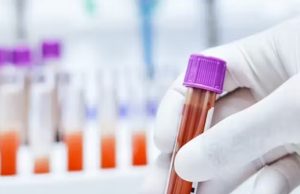 Exame de sangue revolucionário para pacientes com câncer de mama e pulmão evita quimioterapia