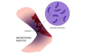 Bactérias comedoras de carne a causa da fasciíte necrosante; entenda como ocorre a doença no corpo
