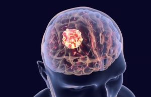 MAIOR AVANÇO EM 20 ANOS: Anvisa aprova medicamento que impede crescimento de tumor cerebral