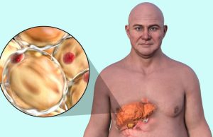 Gordura no fígado é grave? Veja sintomas e como tratar