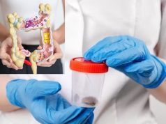 Novo teste de cocô detecta câncer de cólon com 90% de precisão