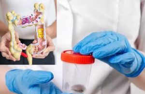 Novo teste de cocô detecta câncer de cólon com 90% de precisão