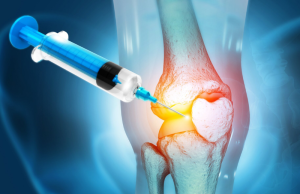 Terapia Inovadora: injeção antienvelhecimento regenera cartilagem do joelho e previne artrite