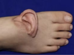 Caso raro: orelha arrancada em acidente é preservada no pé e reimplantada com sucesso