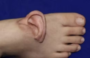 Caso raro: orelha arrancada em acidente é preservada no pé e reimplantada com sucesso