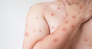 Alerta de Mpox em MT: SES emite alerta urgente sobre Mpox após avanço da doença em estado vizinho