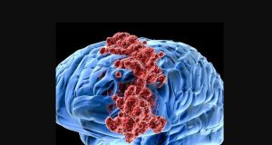 Pesquisadores brasileiros desenvolvem moléculas que matam câncer cerebral