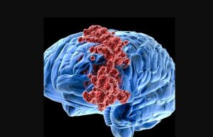Pesquisadores brasileiros desenvolvem moléculas que matam câncer cerebral
