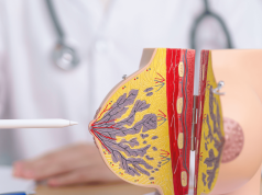 Novo teste genético pode poupar milhares de mulheres da quimioterapia no tratamento do câncer de mama