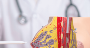 Novo teste genético pode poupar milhares de mulheres da quimioterapia no tratamento do câncer de mama